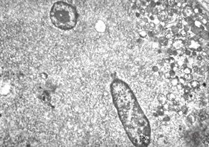 F,25y. | myopathy - atrophic and regenerating muscle cells F,25y. | myopathy - atrophic and regenerating muscle cells